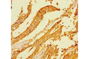 Immunohistochemistry of paraffin-embedded human endometrial cancer using ABIN7165442 at dilution of 1:100 (FAM167A 抗体  (AA 1-214))