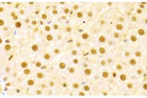 Immunohistochemistry of paraffin-embedded Human liver damage using CDC25A Polyclonal Antibody at dilution of 1:100 (40x lens). (CDC25A 抗体)
