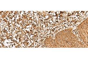 Immunohistochemistry of paraffin-embedded Human esophagus cancer tissue using FAM200A Polyclonal Antibody at dilution of 1:55(x200) (FAM200A 抗体)