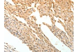The image on the left is immunohistochemistry of paraffin-embedded Human cervical cancer tissue using ABIN7130780(PTPRE Antibody) at dilution 1/10, on the right is treated with fusion protein. (PTPRE 抗体)