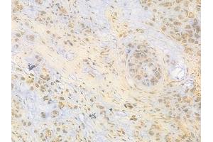 ABIN6263454 and ABIN6269077 at 1/100 staining human gastric carcinoma by IHC-P.
