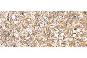 Immunohistochemistry of paraffin-embedded Human liver cancer tissue using PTPRS Polyclonal Antibody at dilution of 1:110(x200) (PTPRS 抗体)