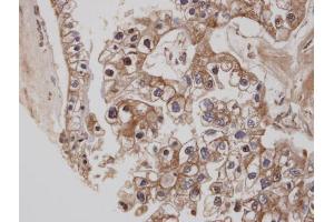 IHC-P Image Immunohistochemical analysis of paraffin-embedded human ovarian cancer, using CB1 , antibody at 1:100 dilution. (CNR1 抗体  (C-Term))