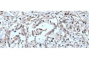 Immunohistochemistry of paraffin-embedded Human gastric cancer tissue using GJA5 Polyclonal Antibody at dilution of 1:50(x200) (Cx40/GJA5 抗体)