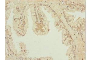 Immunohistochemistry of paraffin-embedded human prostate cancer using ABIN7156889 at dilution of 1:100 (IL31RA 抗体  (AA 1-300))