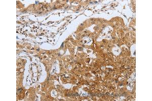 Immunohistochemistry of Human lung cancer using CASP12 Polyclonal Antibody at dilution of 1:50 (Caspase 12 抗体)