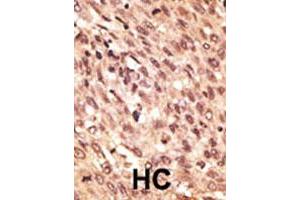 Formalin-fixed and paraffin-embedded human hepatocellular carcinoma tissue reacted with LRP5 polyclonal antibody , which was peroxidase-conjugated to the secondary antibody, followed by AEC staining. (LRP5 抗体  (C-Term))
