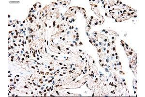 Immunohistochemical staining of paraffin-embedded Adenocarcinoma of breast tissue using anti-TYRO3 mouse monoclonal antibody. (TYRO3 抗体)