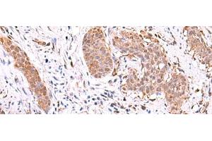 Immunohistochemistry of paraffin-embedded Human esophagus cancer tissue using RUSC1 Polyclonal Antibody at dilution of 1:90(x200) (RUSC1 抗体)