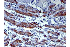 Formalin-fixed, paraffin-embedded human Leiomyosarcoma stained with Caldesmon Mouse Monoclonal Antibody (h-CALD). (Caldesmon 抗体)