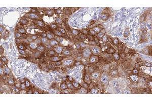 ABIN6276799 at 1/100 staining Human Head and neck cancer tissue by IHC-P. (SELPLG 抗体  (N-Term))