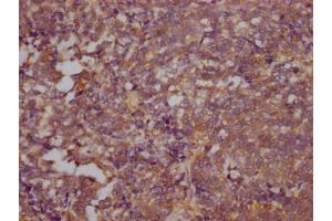 IHC image of ABIN7127794 diluted at 1:100 and staining in paraffin-embedded human lung cancer performed on a Leica BondTM system. (Recombinant RHOA 抗体)