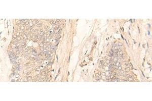 Immunohistochemistry of paraffin-embedded Human esophagus cancer tissue using GK5 Polyclonal Antibody at dilution of 1:35(x200) (GK5 抗体)