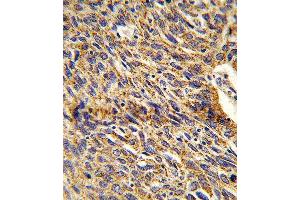 Formalin-fixed and paraffin-embedded human lung carcinoma reacted with DCI Antibody (C-term), which was peroxidase-conjugated to the secondary antibody, followed by DAB staining. (DCI 抗体  (C-Term))