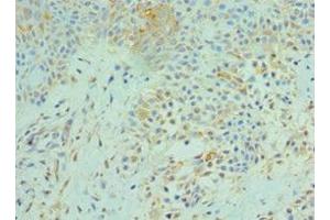 Immunohistochemistry of paraffin-embedded human breast cancer using ABIN7170676 at dilution of 1:100 (SRPK1 抗体  (AA 290-480))