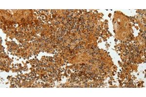 Immunohistochemistry of paraffin-embedded Human tonsil tissue using TFF2 Polyclonal Antibody at dilution 1:40 (Trefoil Factor 2 抗体)