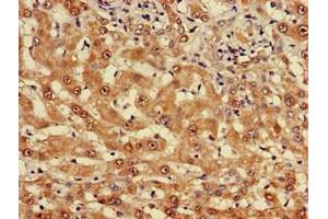 Immunohistochemistry of paraffin-embedded human liver cancer using ABIN7174961 at dilution of 1:100 (Myosin VIIA 抗体  (AA 838-968))