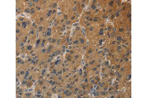 Immunohistochemistry of Human thyroid cancer using DUSP23 Polyclonal Antibody at dilution of 1:30 (DUSP23 抗体)