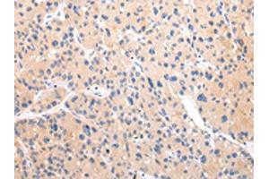 The image on the left is immunohistochemistry of paraffin-embedded Human liver cancer tissue using ABIN7193105(ZNF106 Antibody) at dilution 1/20, on the right is treated with synthetic peptide. (ZNF16 抗体)