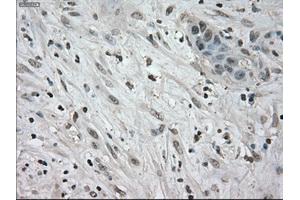 Immunohistochemical staining of paraffin-embedded Carcinoma of kidney tissue using anti-NEK6mouse monoclonal antibody. (NEK6 抗体)