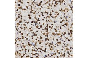 Immunohistochemistry of paraffin-embedded human kidney cancer tissue using H4K20me3 antibody at dilution of 1:200 (x400 lens). (Histone H4 抗体  (3meLys20))