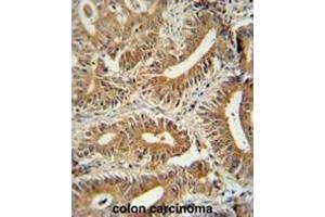 CCDC123 antibody (C-term) immunohistochemistry analysis in formalin fixed and paraffin embedded human colon carcinoma followed by peroxidase conjugation of the secondary antibody and DAB staining. (CEP89 抗体  (C-Term))
