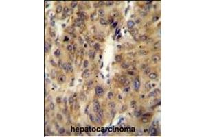 ACF Antibody (C-term) (ABIN654627 and ABIN2844324) immunohistochemistry analysis in formalin fixed and paraffin embedded human hepatocarcinoma followed by peroxidase conjugation of the secondary antibody and DAB staining. (A1CF 抗体  (C-Term))