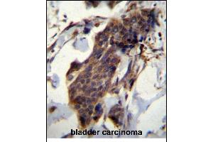 CCDC13 Antibody (N-term) (ABIN656615 and ABIN2845868) immunohistochemistry analysis in formalin fixed and paraffin embedded human bladder carcinoma followed by peroxidase conjugation of the secondary antibody and DAB staining. (CCDC13 抗体  (N-Term))