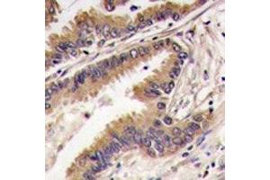 IHC analysis of FFPE human lung carcinoma tissue stained with ERK4 antibody (MAPK7 抗体  (AA 527-557))