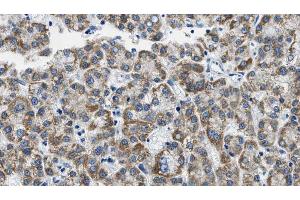 ABIN6268888 at 1/100 staining Human liver cancer tissue by IHC-P. (CD4 抗体  (C-Term))
