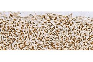 Immunohistochemistry of paraffin-embedded Human lung cancer tissue using TP63 Polyclonal Antibody at dilution of 1:65(x200) (p63 抗体)