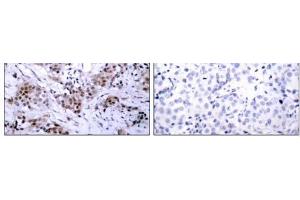 Immunohistochemical analysis of paraffin-embedded human breast carcinoma tissue using Estrogen Receptor-α (Ab-167) antibody (E021068). (Estrogen Receptor alpha 抗体)
