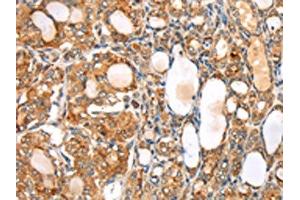 The image on the left is immunohistochemistry of paraffin-embedded Human thyroid cancer tissue using ABIN7192531(SLC8B1 Antibody) at dilution 1/20, on the right is treated with synthetic peptide. (SLC24A6 抗体)