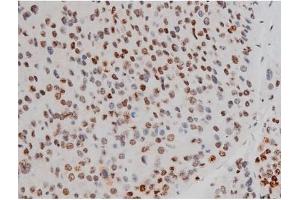 ABIN6267389 at 1/200 staining Human liver cancer tissue sections by IHC-P. (ATF2 抗体  (pThr51, pThr69))