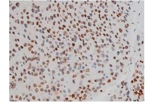 ABIN6267389 at 1/200 staining Human liver cancer tissue sections by IHC-P.