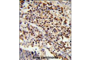 Formalin-fixed and paraffin-embedded human lung carcinoma reacted with , which was peroxidase-conjugated to the secondary antibody, followed by DAB staining. (U2AF1 抗体  (AA 99-125))