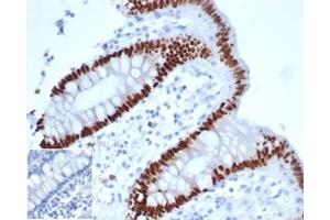 IHC analysis of formalin-fixed, paraffin-embedded human colon adenocarcinoma. (Recombinant CDX2 抗体)
