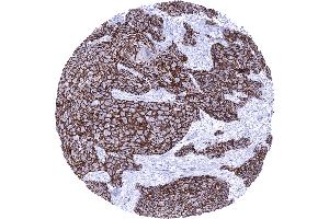 Squamous cell carcinoma of the penis with intense membranous Dsg3 immunostaining of tumor cells (Desmoglein 3 抗体  (AA 379-491))