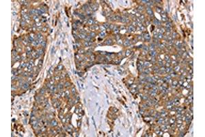 The image on the left is immunohistochemistry of paraffin-embedded Human cervical cancer tissue using ABIN7129551(FUCA1 Antibody) at dilution 1/30, on the right is treated with fusion protein. (FUCA1 抗体)