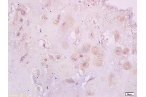 Formalin-fixed and paraffin embedded human placenta tissue labeled with Anti-Phospho-Estrogen Receptor alpha (Ser118) Polyclonal Antibody, Unconjugated (ABIN684568) at 1:200 followed by conjugation to the secondary antibody and DAB staining (Estrogen Receptor alpha 抗体  (pSer118))