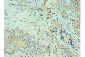 Immunohistochemistry of paraffin-embedded human breast cancer using ABIN7146211 at dilution of 1:100 (Cadherin 13 抗体  (AA 120-370))