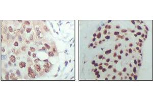 Immunohistochemical analysis of paraffin-embedded human esophagus cancer (left) and breast carcinoma tissue (right), showing nuclear localization with DAB staining using HDAC3 mouse mAb. (HDAC3 抗体  (AA 224-428))