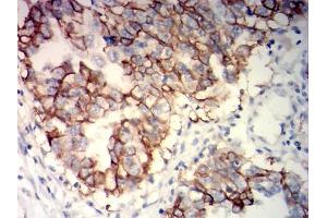 Immunohistochemical analysis of paraffin-embedded ovarian cancer tissues using NCAM1 mouse mAb with DAB staining. (CD56 抗体)