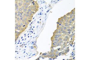 Immunohistochemistry of paraffin-embedded human lung cancer using EIF4E antibody (ABIN5971189) at dilution of 1/100 (40x lens). (EIF4E 抗体)