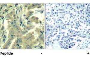 Immunohistochemical analysis of paraffin-embedded human lung carcinoma tissue using PLCG2 polyclonal antibody . (Phospholipase C gamma 2 抗体  (Tyr1217))