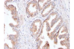 Formalin-fixed, paraffin-embedded human Prostate Carcinoma stained with FOLH1 Rabbit Recombinant Monoclonal Antibody (FOLH1/3149R). (Recombinant PSMA 抗体  (AA 232-433))