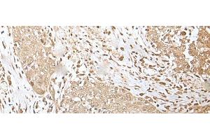 Immunohistochemistry of paraffin-embedded Human esophagus cancer tissue using ZKSCAN3 Polyclonal Antibody at dilution of 1:50(x200) (ZKSCAN3 抗体)