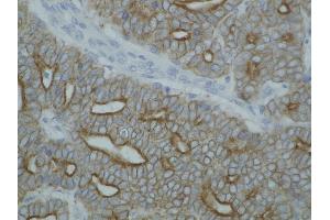 Detection of cytokeratin on paraffin-embedded sections of guinea pig breast carcinoma using anti-cytokeratin antibody (pan Keratin 抗体  (PE))