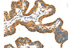The image on the left is immunohistochemistry of paraffin-embedded Human thyroid cancer tissue using ABIN7192934(TRPV5 Antibody) at dilution 1/25, on the right is treated with synthetic peptide. (TRPV5 抗体)