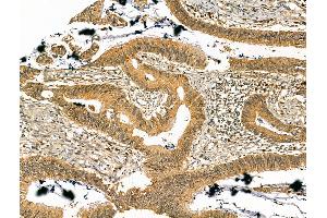 ABIN7094431 and ABIN7098479 at 1/100 staining Human colorectal cancer by IHC-P. (PREP 抗体  (Internal Region))